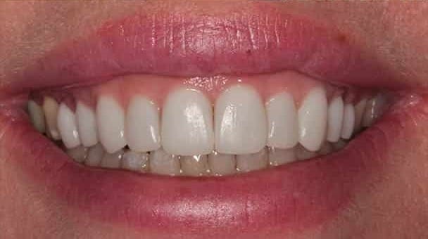 After Image: Porcelain Veneers - front
