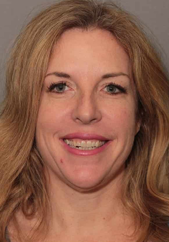 Before Image: Porcelain Veneers - front