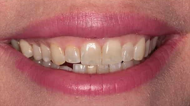 Before Image: Porcelain Veneers - front