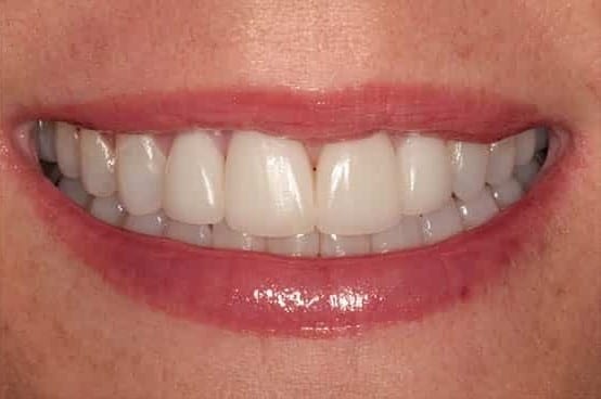 After Image: Porcelain Veneers - front