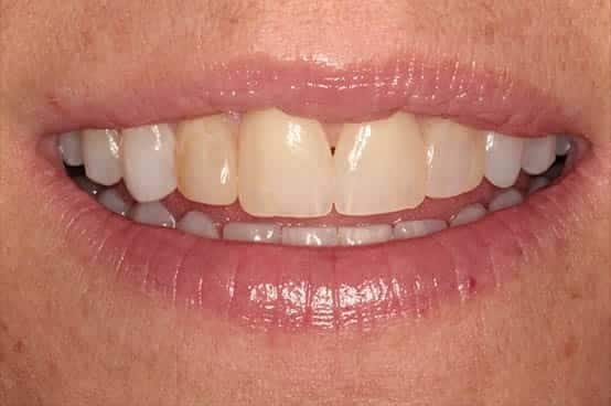 Before Image: Porcelain Veneers - front