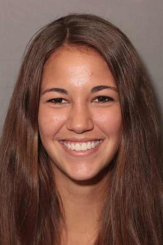 After Image: Porcelain Veneers - front