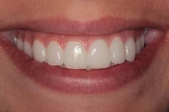 After Image: Porcelain Veneers - front