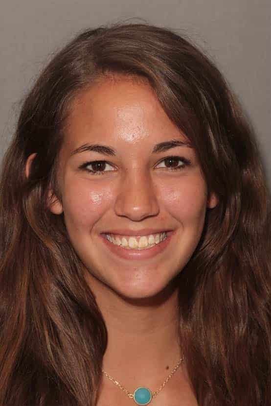 Before Image: Porcelain Veneers - front