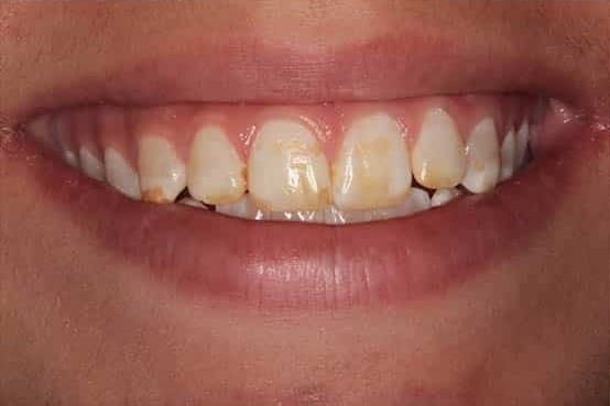 Before Image: Porcelain Veneers - front