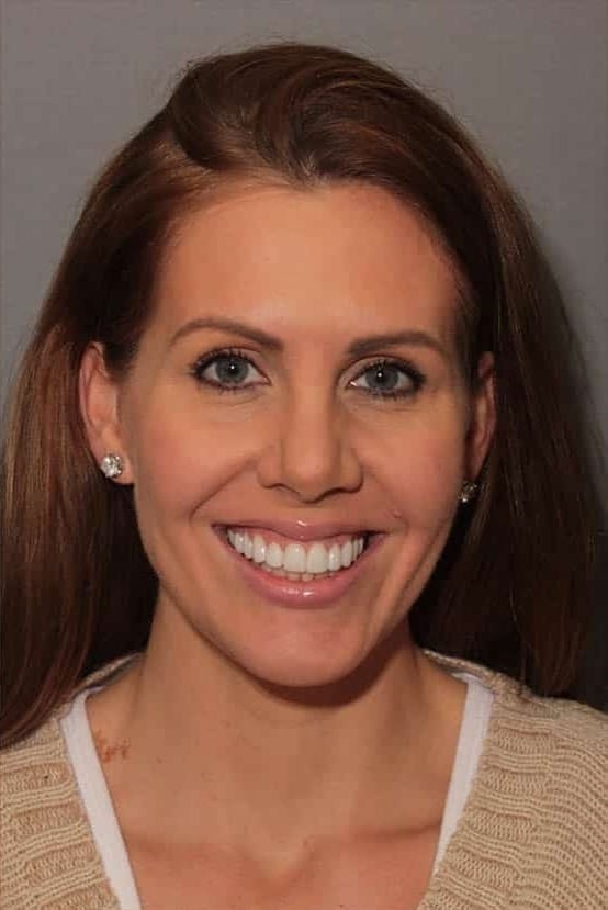 After Image: Porcelain Veneers - front