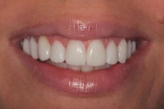 After Image: Porcelain Veneers - front