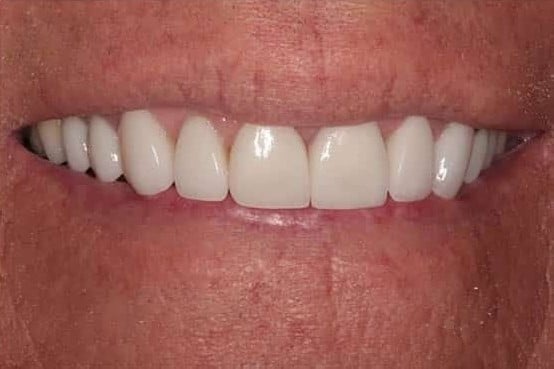 After Image: Porcelain Veneers - front