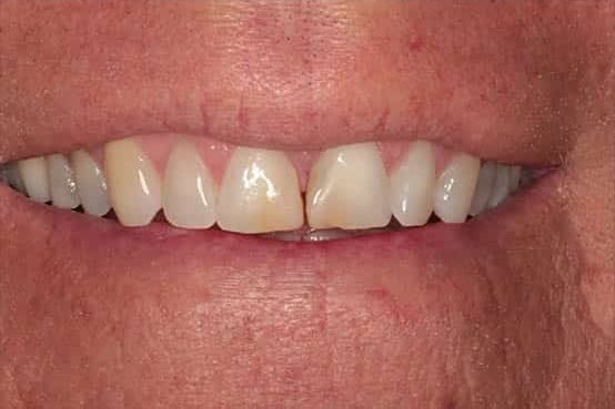 Before Image: Porcelain Veneers - front