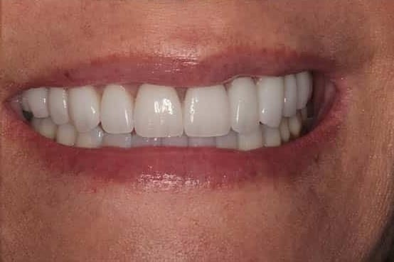 After Image: Porcelain Veneers - front