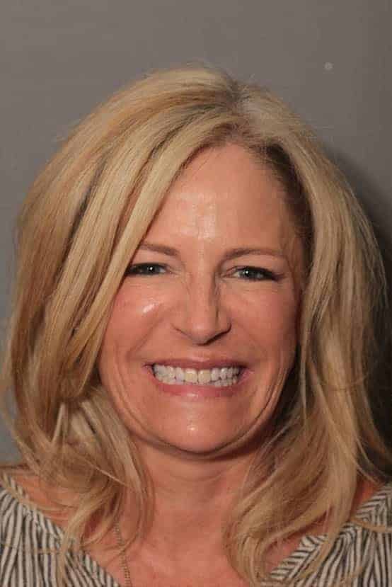 Before Image: Porcelain Veneers - front