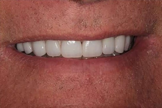 After Image: Porcelain Veneers - front