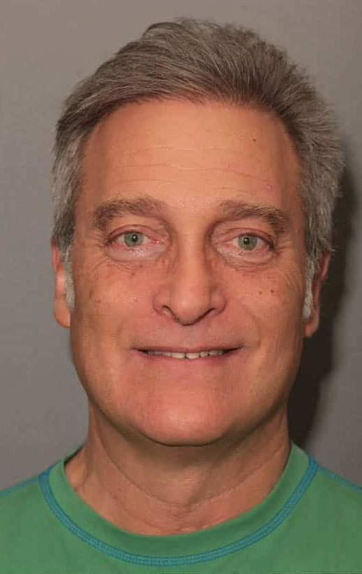 Before Image: Porcelain Veneers - front