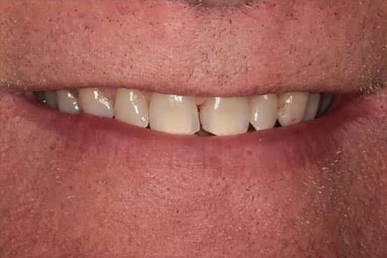 Before Image: Porcelain Veneers - front