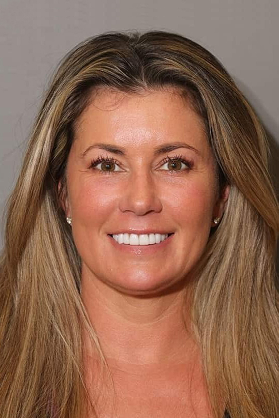 After Image: Porcelain Veneers - front