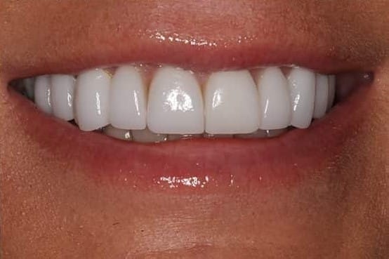 After Image: Porcelain Veneers - front