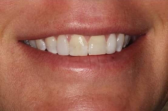 Before Image: Porcelain Veneers - front