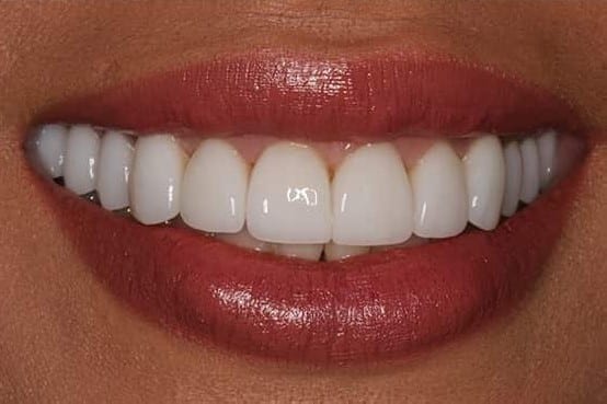 After Image: Porcelain Veneers - front