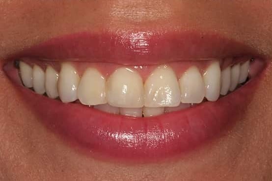 Before Image: Porcelain Veneers - front