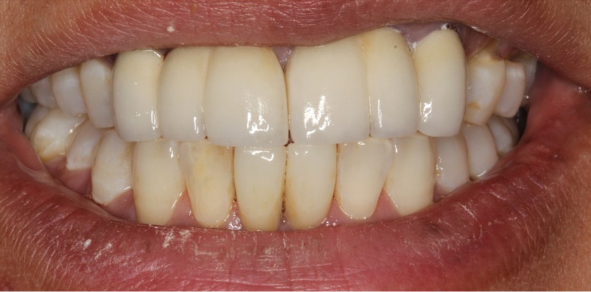 Before Image: Porcelain Crowns & Implant Crowns & Porcelain Bridges - front