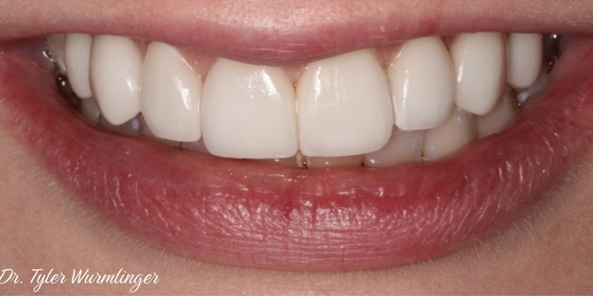 After Image: Porcelain Veneers - front
