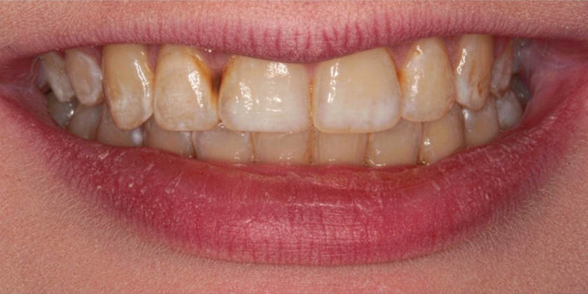 Before Image: Porcelain Veneers - front
