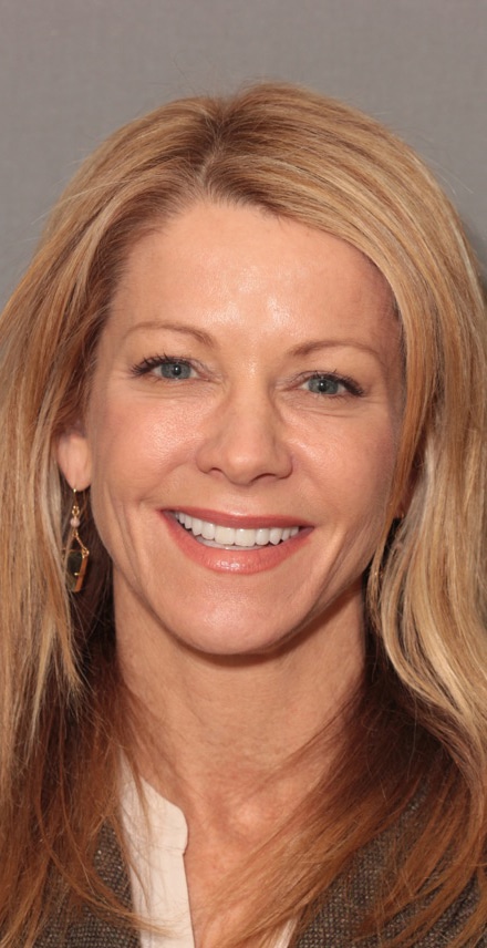 After Image: Porcelain Veneers - front