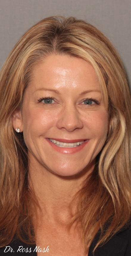 Before Image: Porcelain Veneers - front