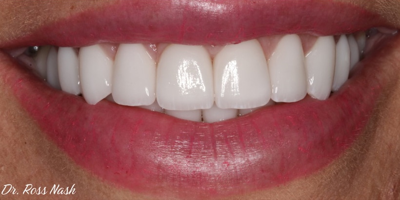 After Image: Porcelain Veneers - front