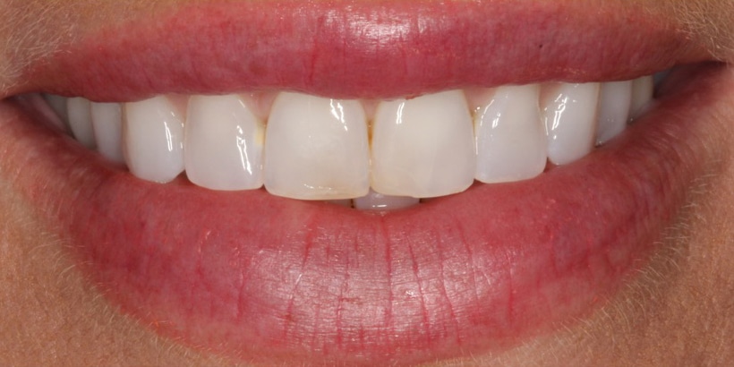 Before Image: Porcelain Veneers - front