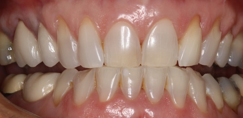 Before Image: Porcelain Crowns – Full Mouth Restorations - front