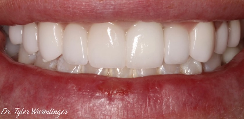 After Image: Porcelain Veneers & Crowns & Implant Crowns – Full Mouth Restorations - front