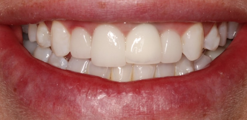 Before Image: Porcelain Veneers & Crowns & Implant Crowns – Full Mouth Restorations - front