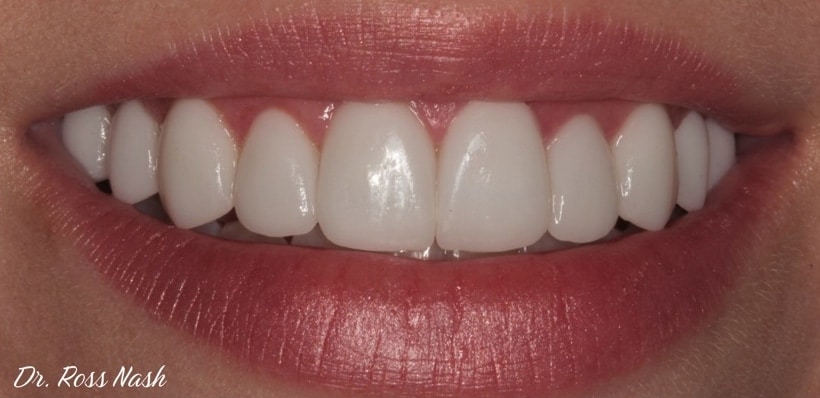 After Image: Porcelain Veneers - front