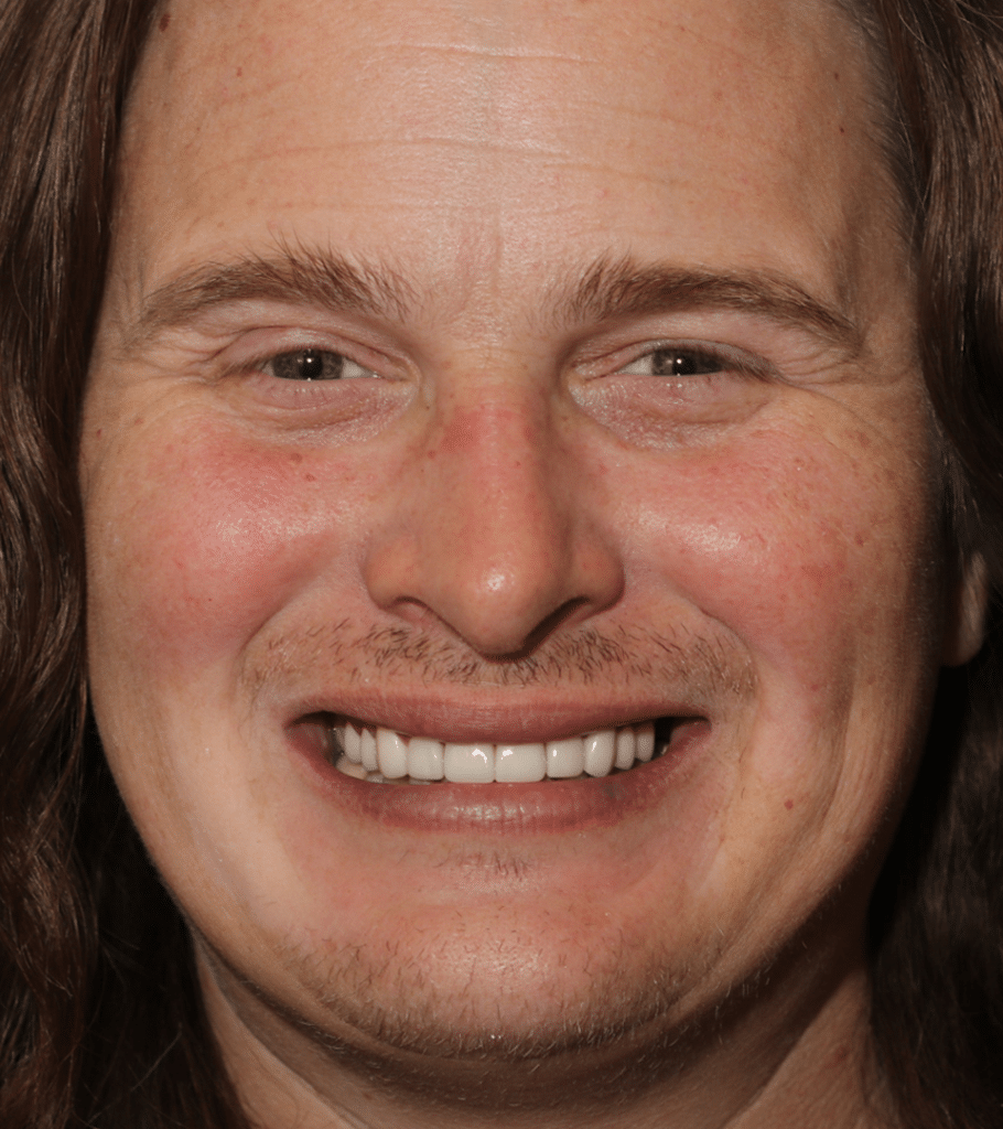 After Image: Porcelain Crowns - front