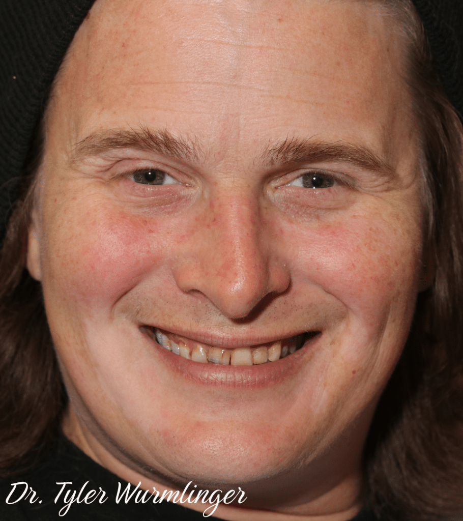 Before Image: Porcelain Crowns - front