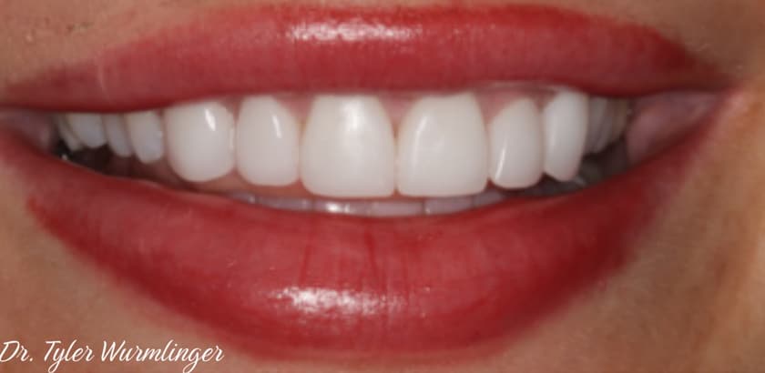 After Image: Porcelain Veneers - front