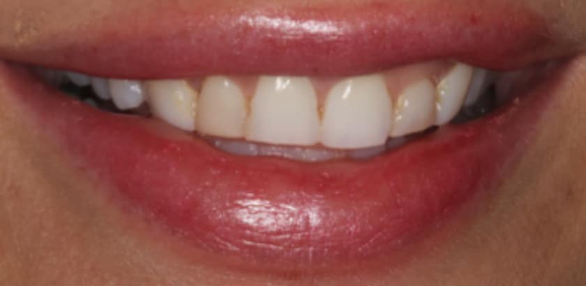 Before Image: Porcelain Veneers - front
