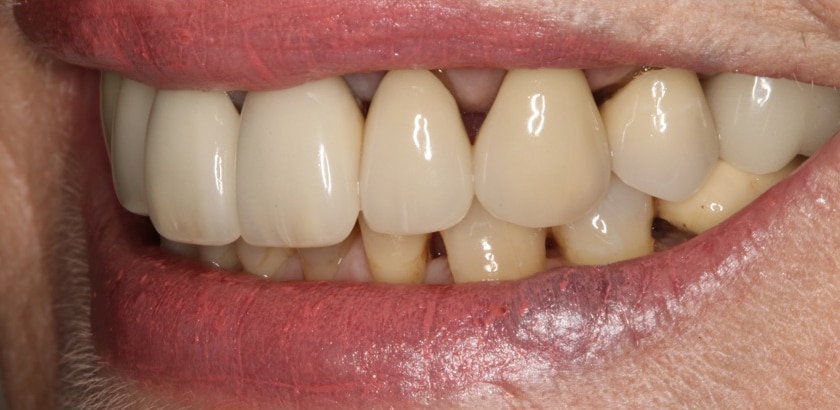 Before Image: Porcelain Crowns – Full Mouth Restorations - left-front-oblique