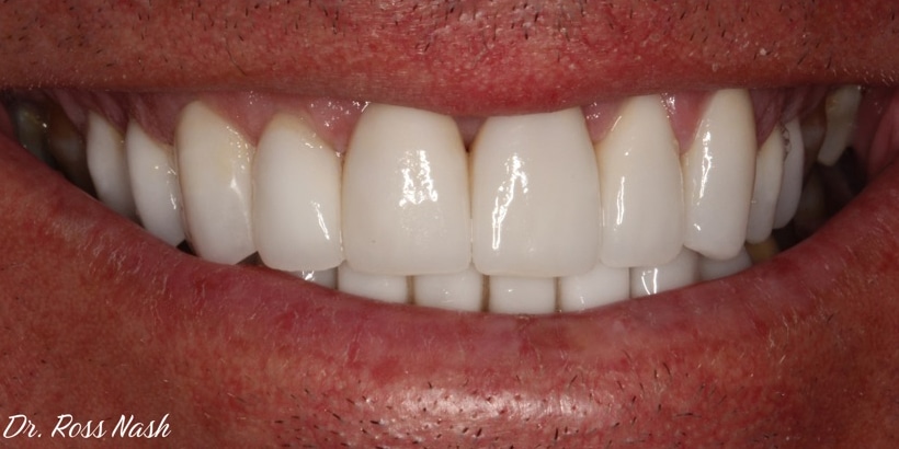 After Image: Full Mouth Rehabilitation - front
