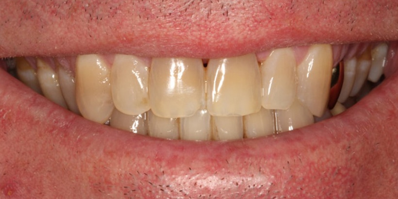 Before Image: Full Mouth Rehabilitation - front