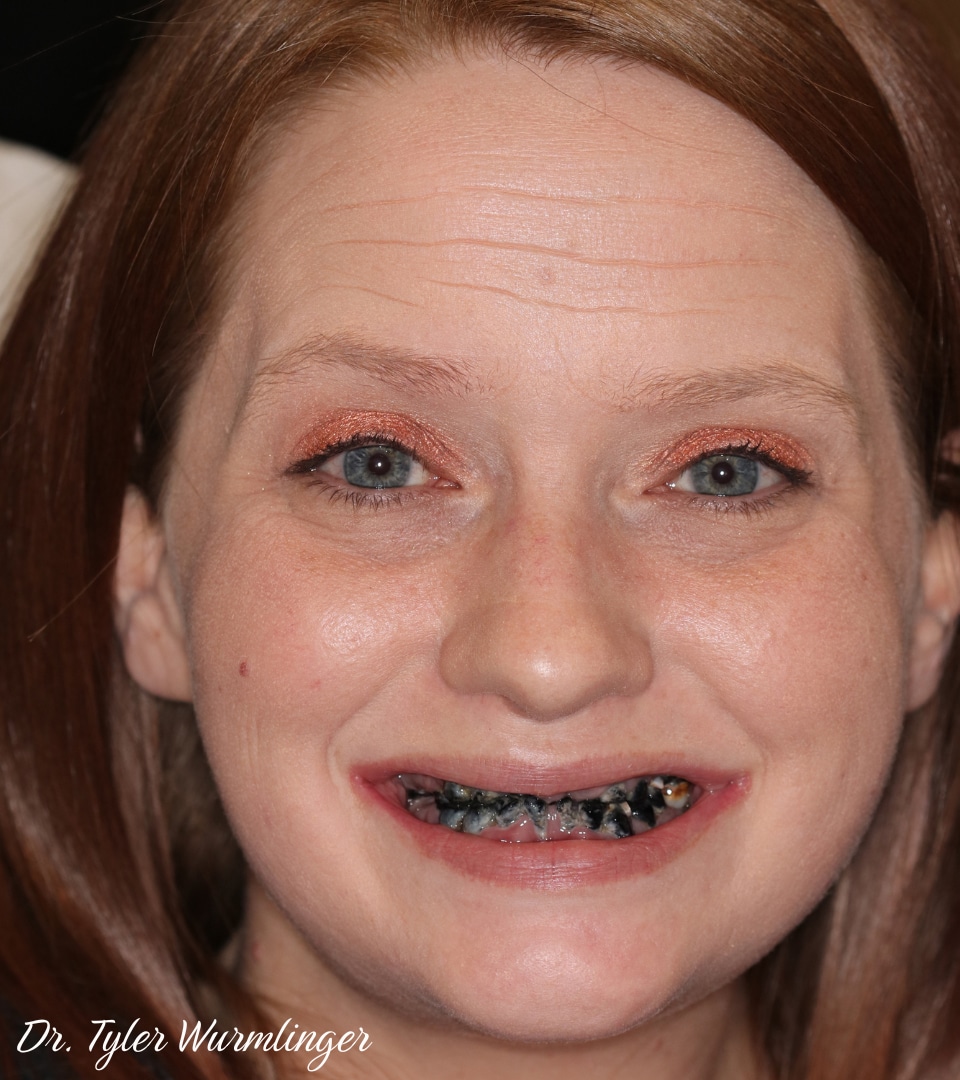 Before Image: Dentures - front