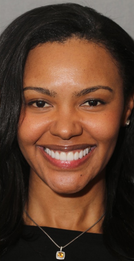 After Image: Porcelain Veneers - front