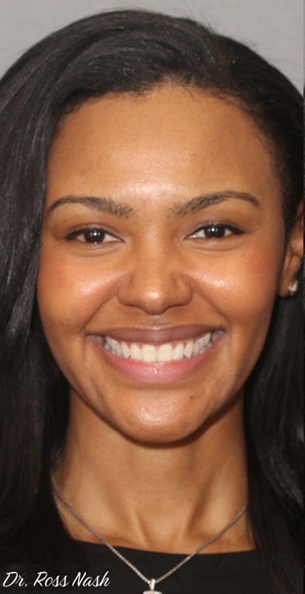 Before Image: Porcelain Veneers - front