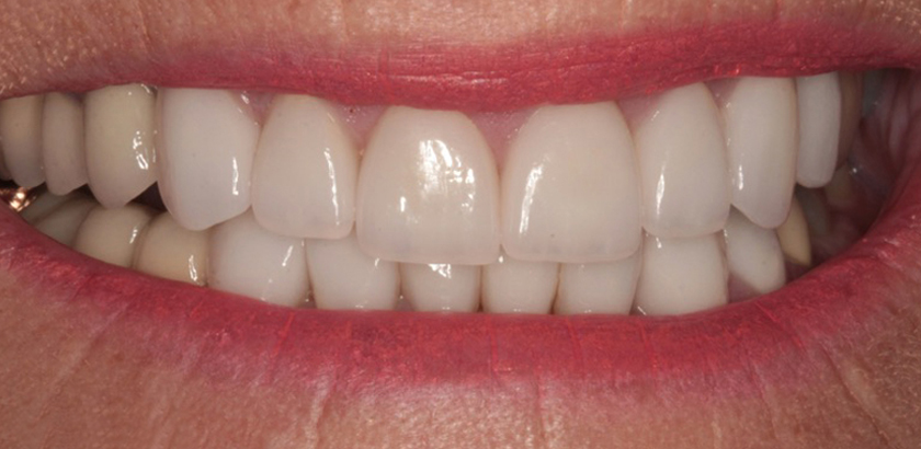 After Image: Porcelain Veneers - front