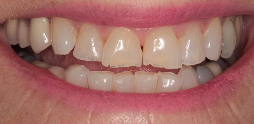 Before Image: Porcelain Veneers - front