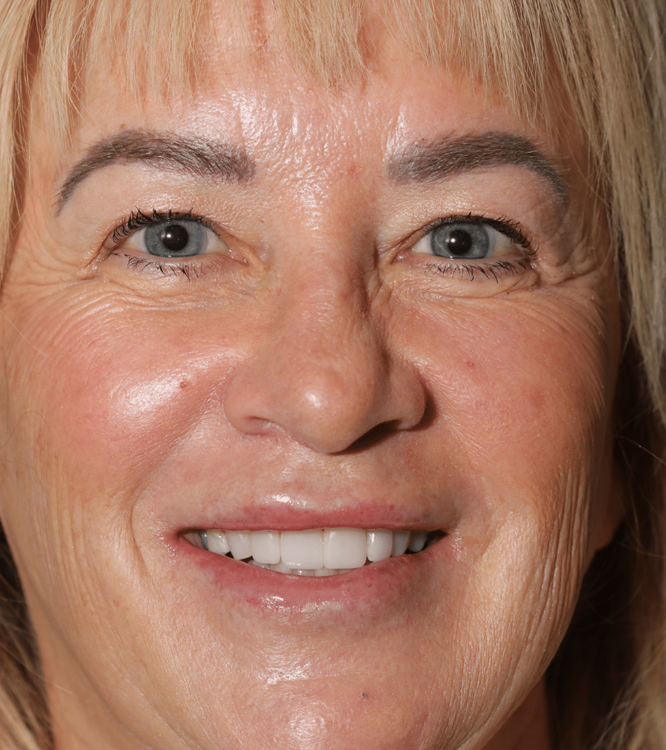 After Image: Porcelain Veneers - front