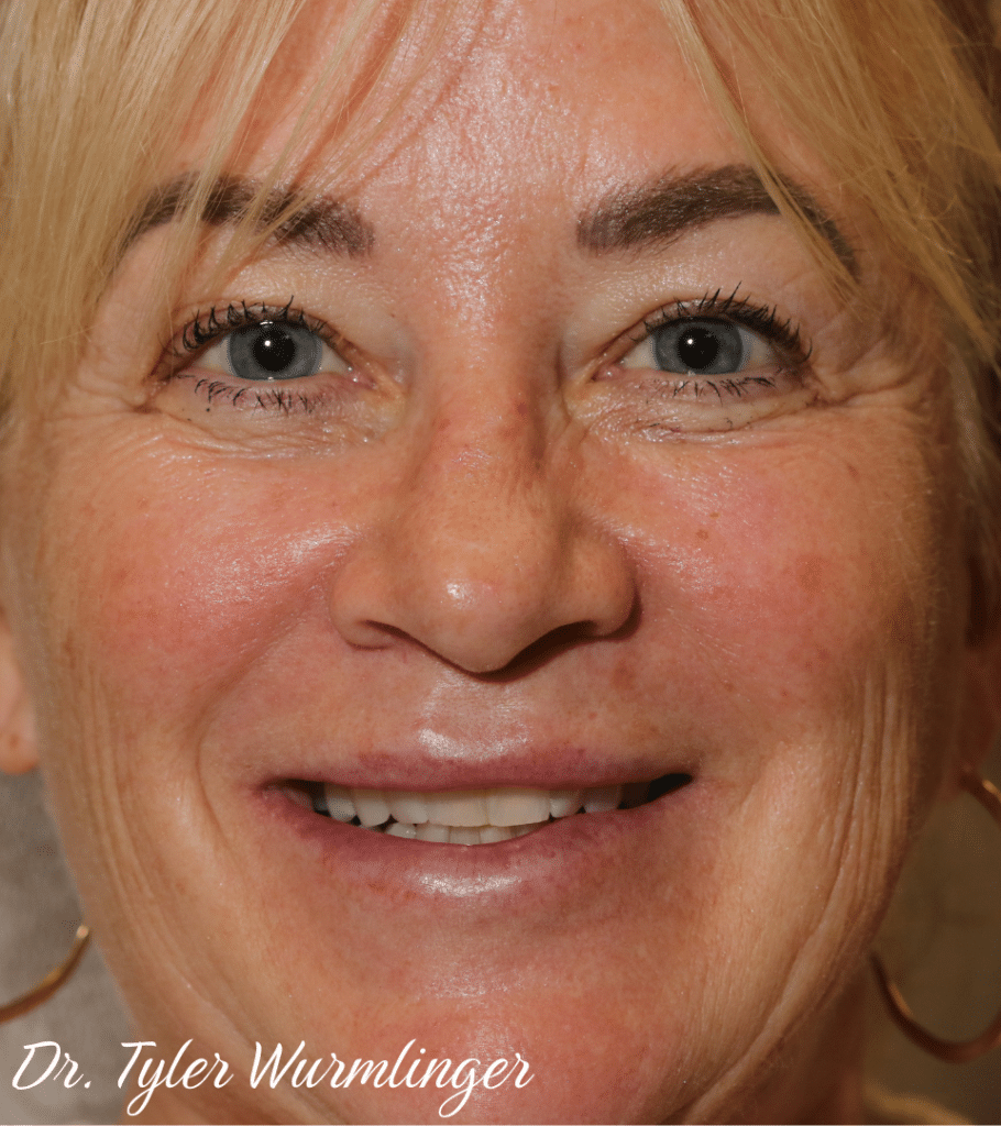 Before Image: Porcelain Veneers - front