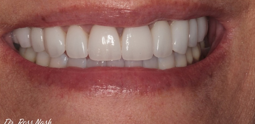 After Image: Porcelain Veneers - front