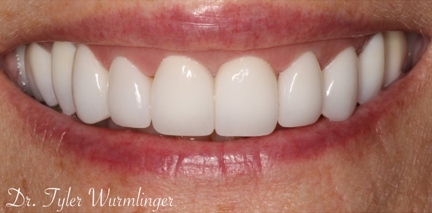 After Image: Porcelain Veneers - front